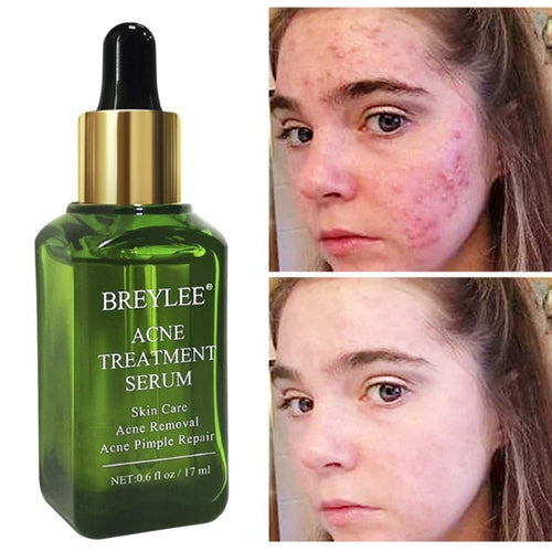 BREYLEE  SÉRUM  encolhedor de poros, para tratamento da acne com essência facial para  remoção de cicatrizes  clareamento anti- ácne e cuidados da pele